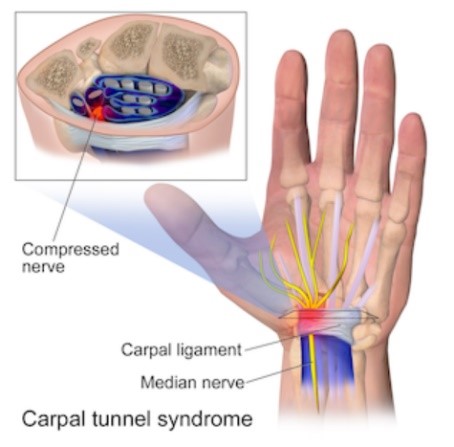 Carpal Tunnel Syndrome